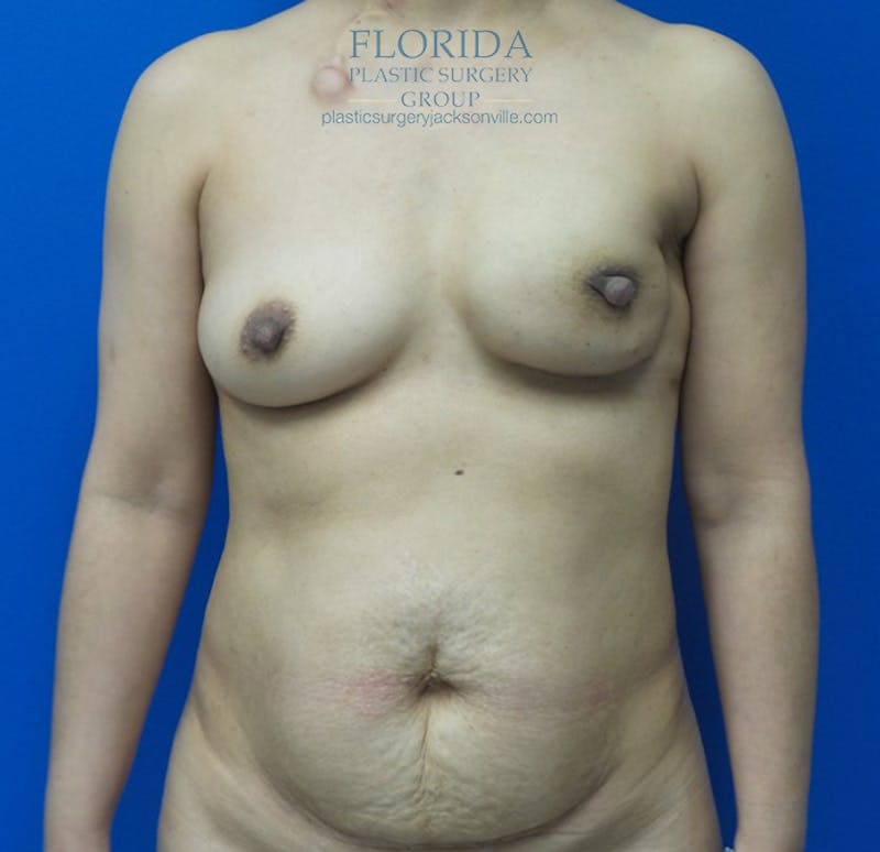 DIEP Flap Reconstruction Before & After Gallery - Patient 154952170 - Image 1
