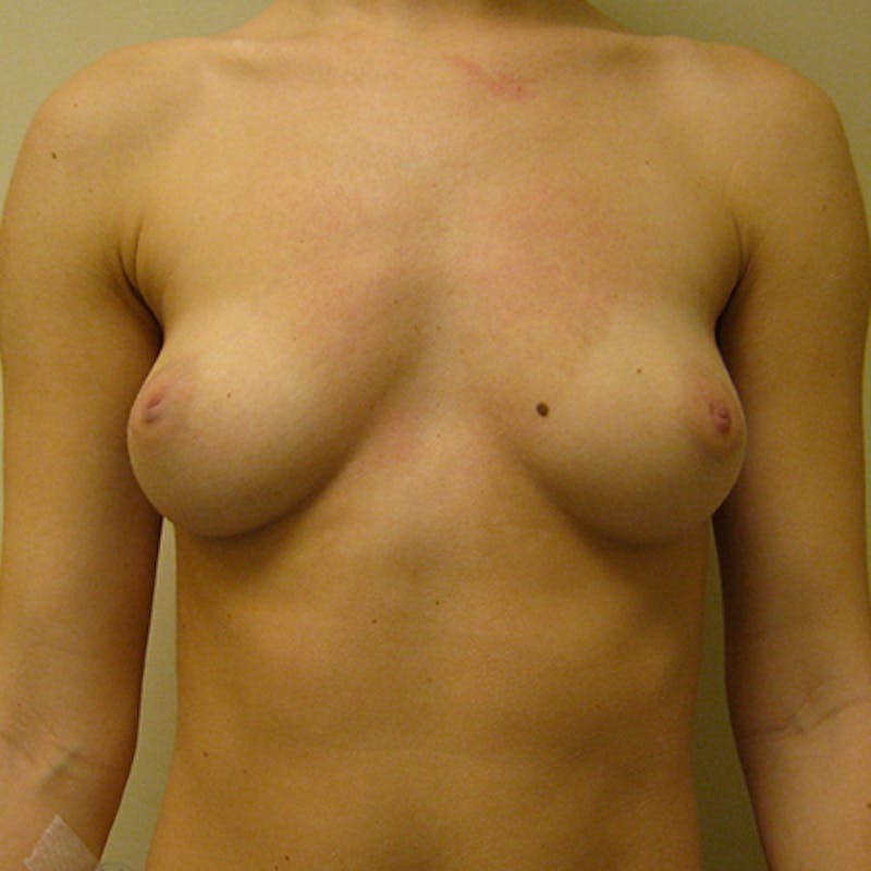 Silicone Breast Augmentation Before & After Gallery - Patient 154952165 - Image 1