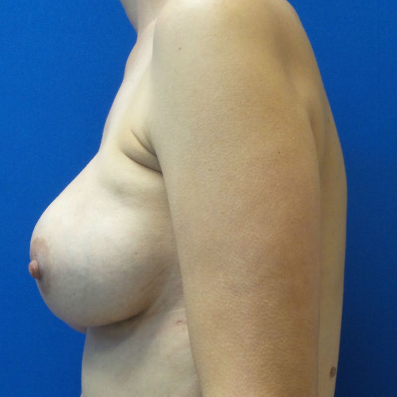 Nipple Sparing Breast Reconstruction Before & After Gallery - Patient 154952161 - Image 6