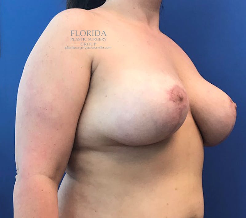 Breast Implant Removal Before & After Gallery - Patient 154952163 - Image 10