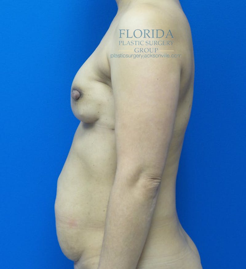 DIEP Flap Reconstruction Before & After Gallery - Patient 154952170 - Image 3