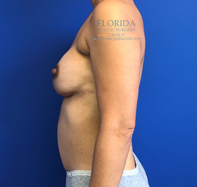 DIEP Flap Reconstruction Before & After Gallery - Patient 154952170 - Image 4