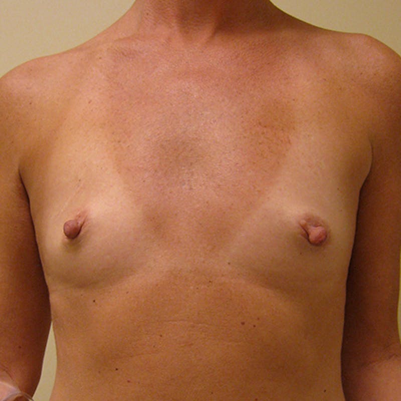 Silicone Breast Augmentation Before & After Gallery - Patient 154952168 - Image 1