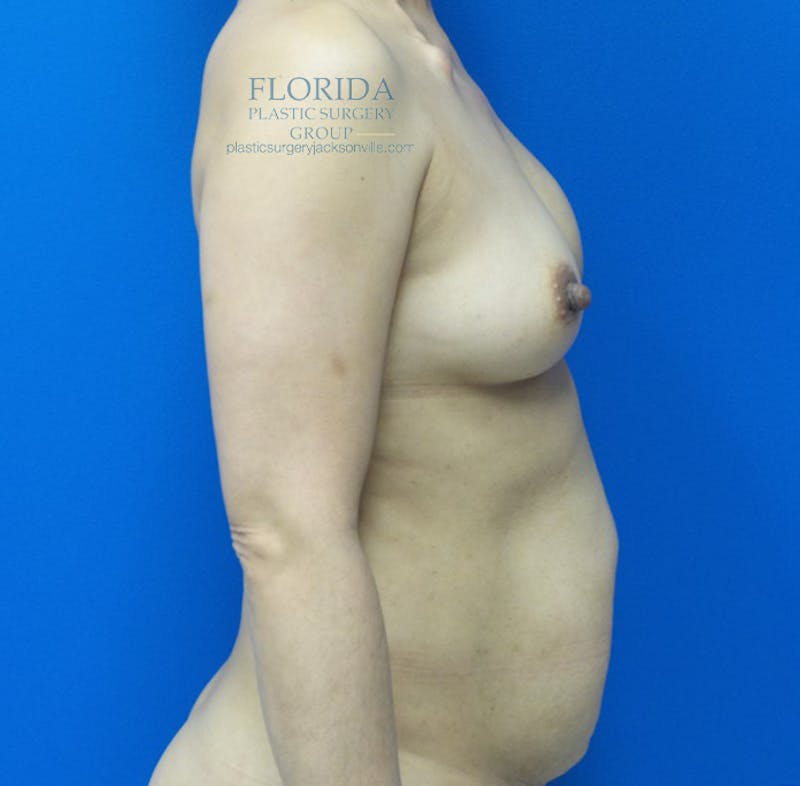 DIEP Flap Reconstruction Before & After Gallery - Patient 154952170 - Image 5
