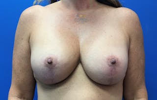 Revision Breast Surgery Before & After Gallery - Patient 154952169 - Image 2