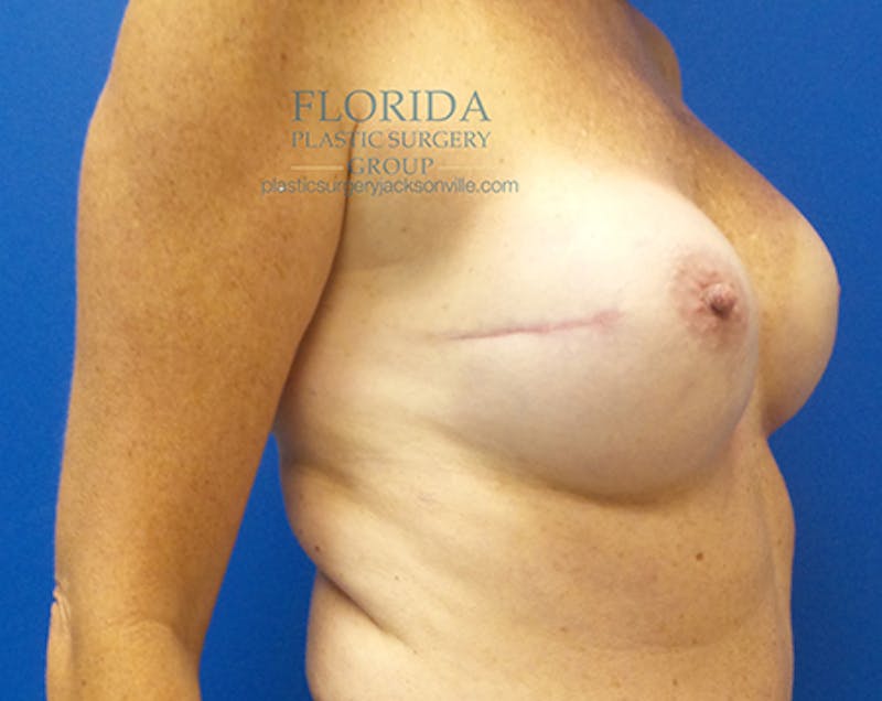 Nipple Sparing Breast Reconstruction Before & After Gallery - Patient 154952171 - Image 4