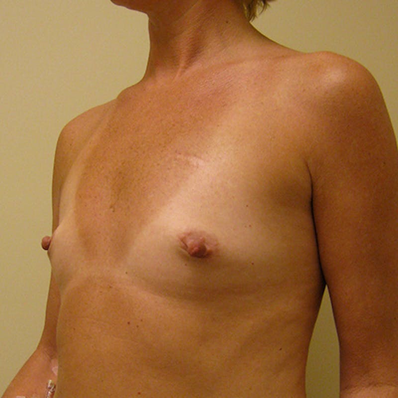Silicone Breast Augmentation Before & After Gallery - Patient 154952168 - Image 3