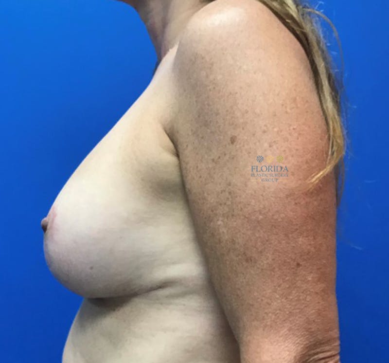 Revision Breast Surgery Before & After Gallery - Patient 154952169 - Image 4