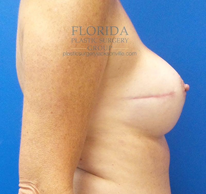 Nipple Sparing Breast Reconstruction Before & After Gallery - Patient 154952171 - Image 6