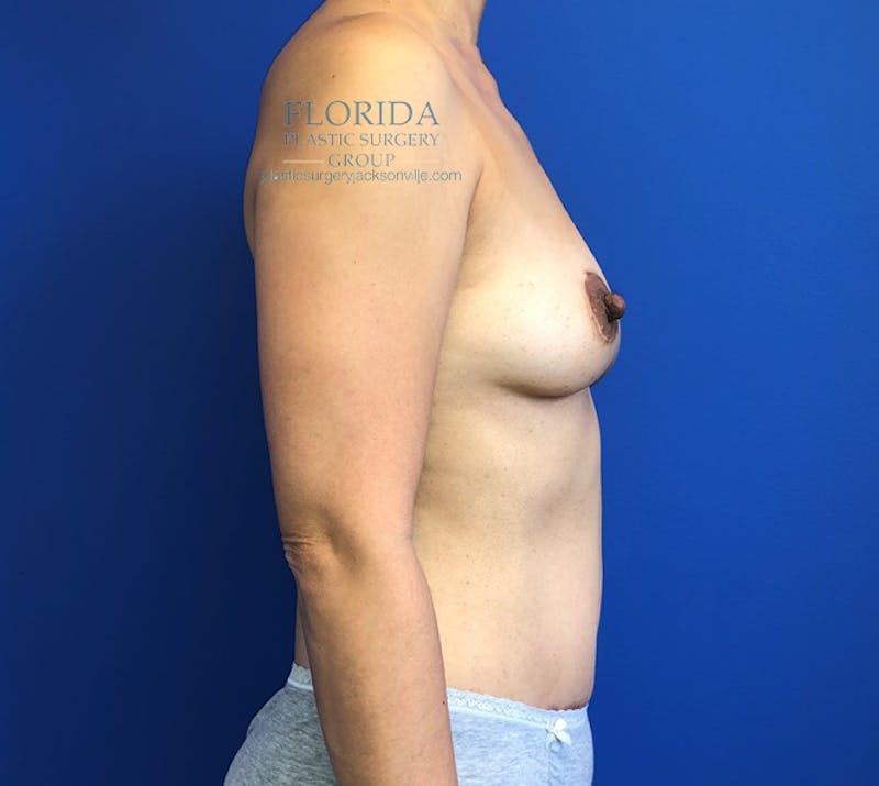DIEP Flap Reconstruction Before & After Gallery - Patient 154952170 - Image 6