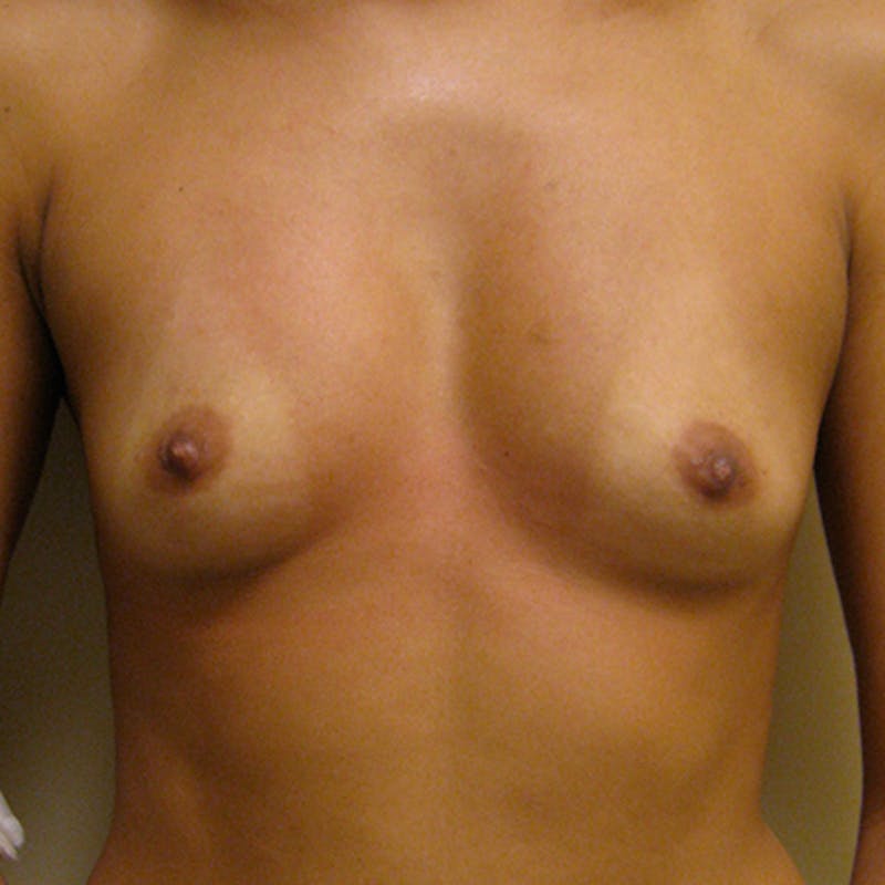 Silicone Breast Augmentation Before & After Gallery - Patient 154952177 - Image 1