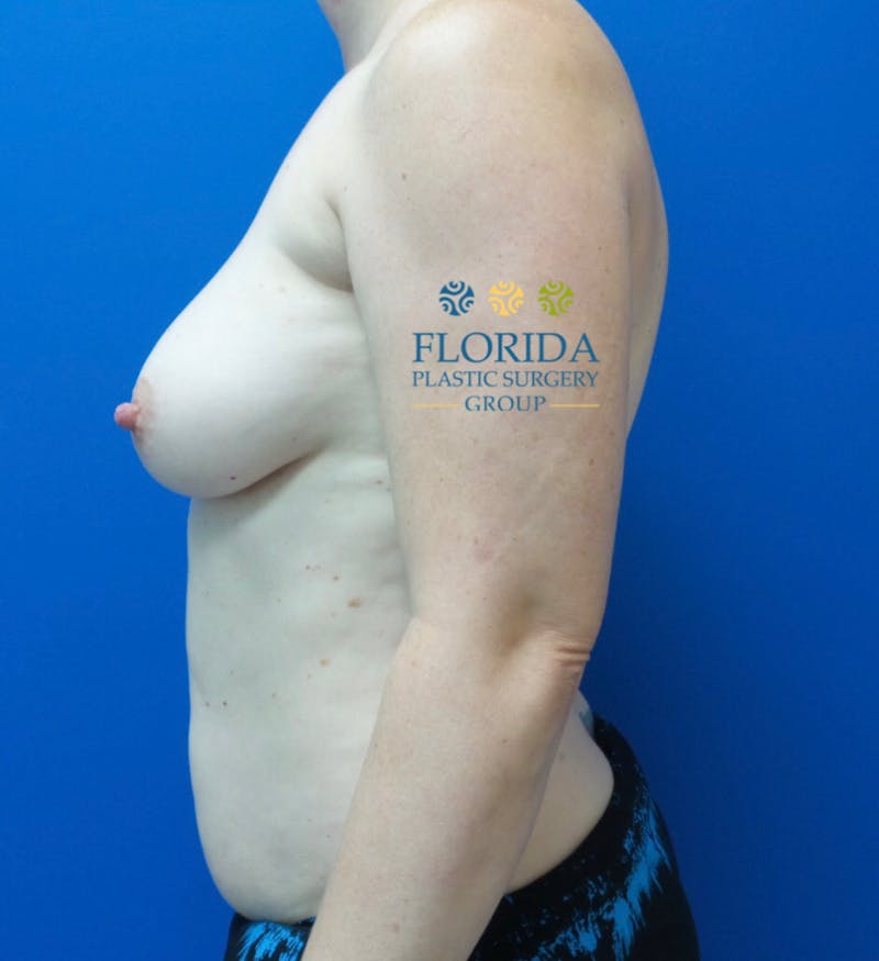 DIEP Flap Reconstruction Before & After Gallery - Patient 154952176 - Image 3