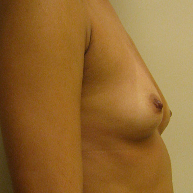 Silicone Breast Augmentation Before & After Gallery - Patient 154952177 - Image 5
