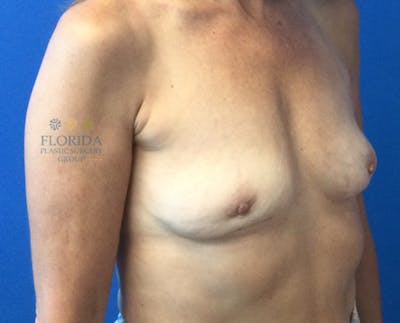 Revision Breast Surgery Before & After Gallery - Patient 154952179 - Image 1