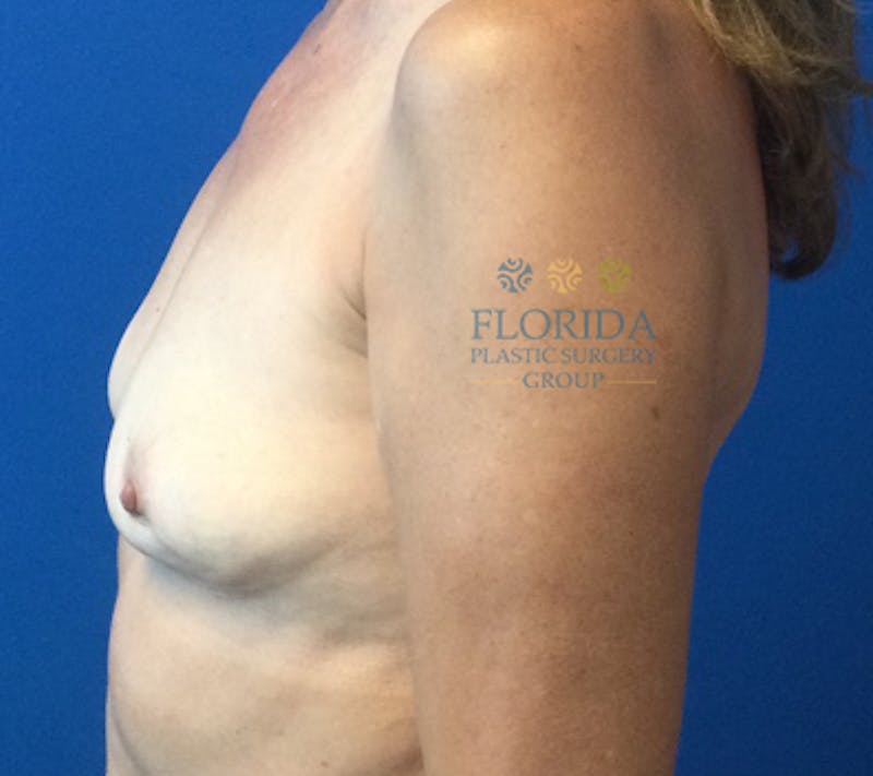 Revision Breast Surgery Before & After Gallery - Patient 154952179 - Image 3