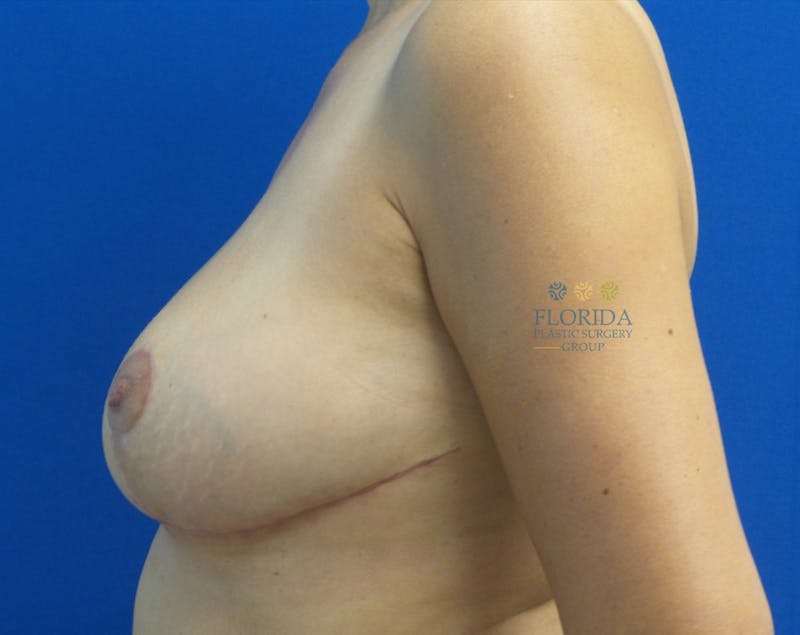 Breast Reduction Before & After Gallery - Patient 154952183 - Image 2