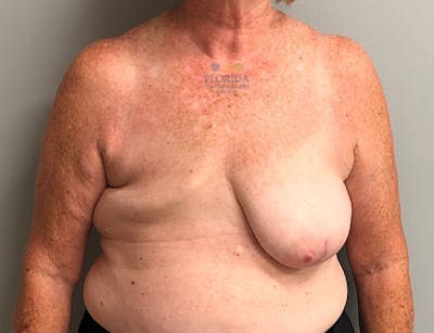 Tissue Expander Reconstruction Before & After Gallery - Patient 154952188 - Image 1