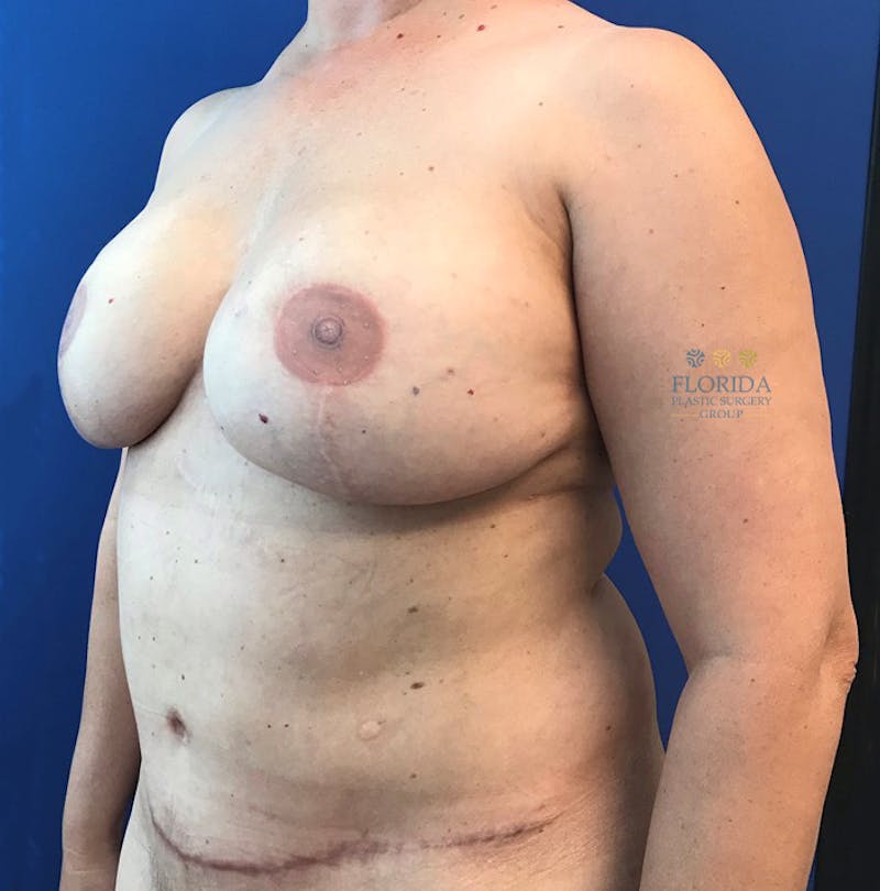 DIEP Flap Reconstruction Before & After Gallery - Patient 154952182 - Image 4