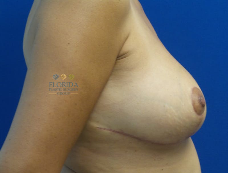 Breast Reduction Before & After Gallery - Patient 154952183 - Image 4
