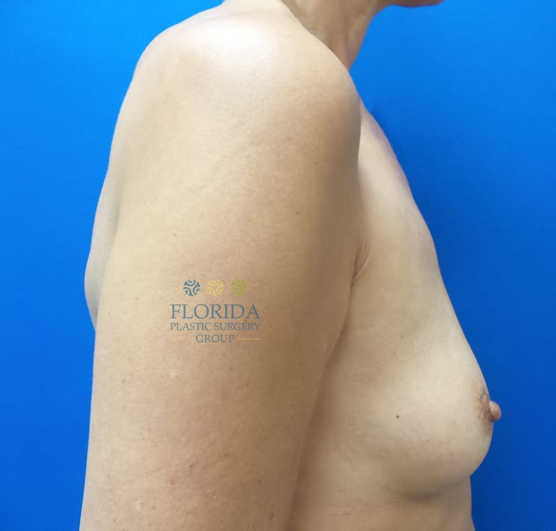 Nipple Sparing Breast Reconstruction Before & After Gallery - Patient 154952184 - Image 3