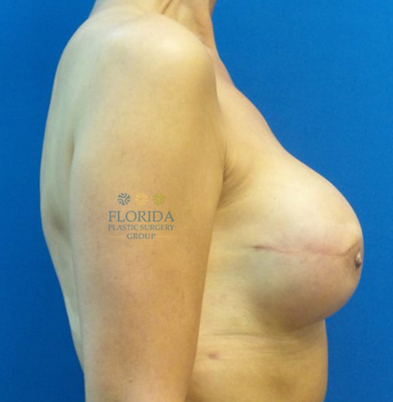 Nipple Sparing Breast Reconstruction Before & After Gallery - Patient 154952184 - Image 4