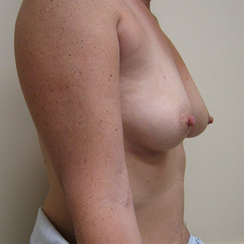 Nipple Sparing Breast Reconstruction Before & After Gallery - Patient 154952189 - Image 3