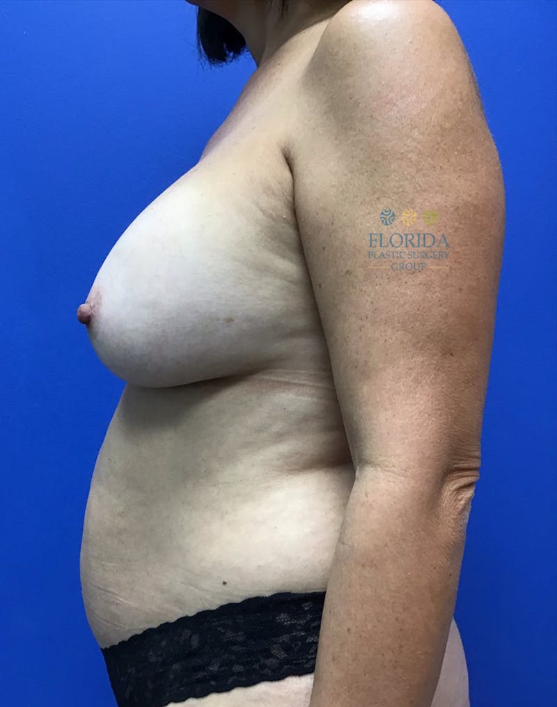 DIEP Flap Reconstruction Before & After Gallery - Patient 154952191 - Image 3