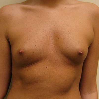 Silicone Breast Augmentation Before & After Gallery - Patient 154952190 - Image 1