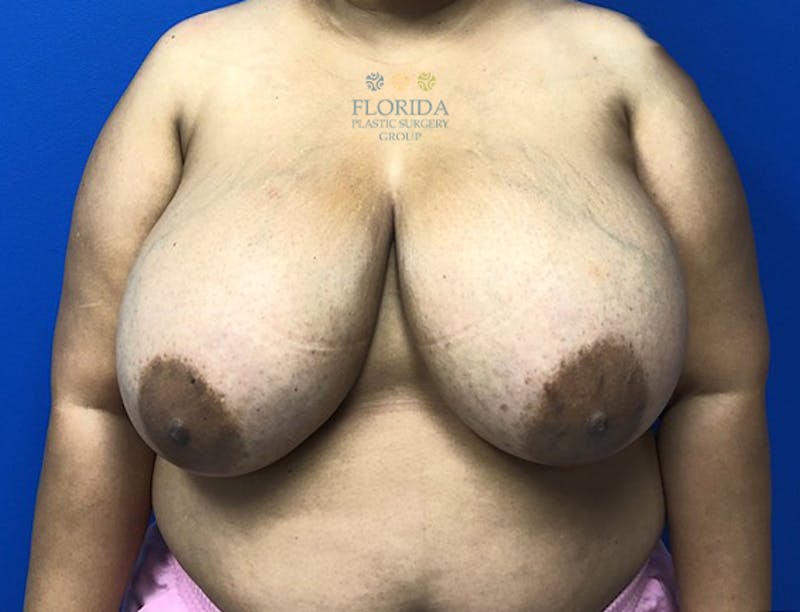 Breast Reduction Before & After Gallery - Patient 154952196 - Image 1