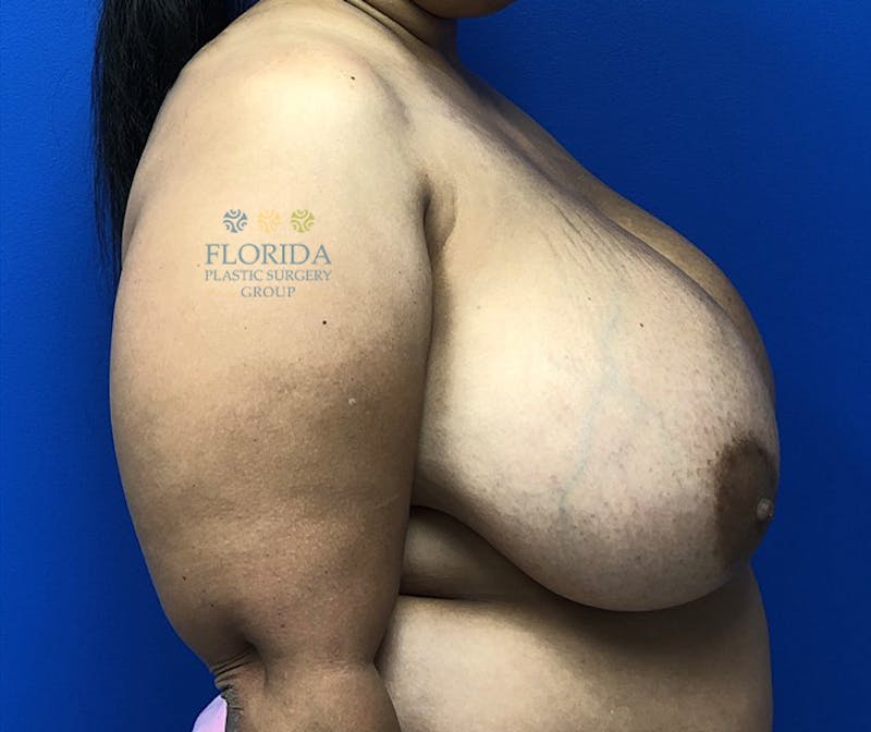 Breast Reduction Before & After Gallery - Patient 154952196 - Image 3