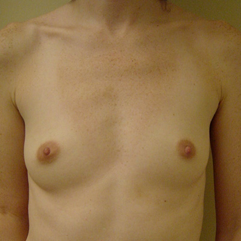Silicone Breast Augmentation Before & After Gallery - Patient 154952194 - Image 1