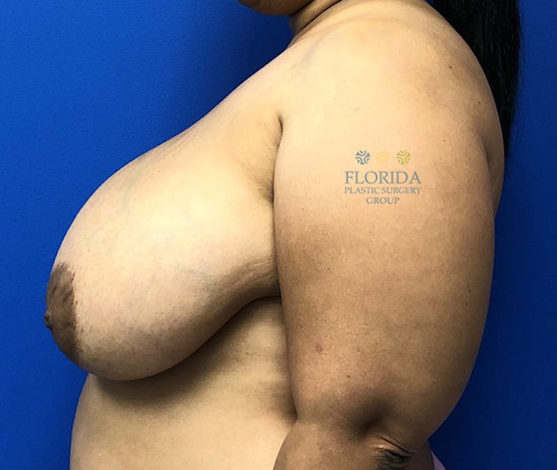Breast Reduction Before & After Gallery - Patient 154952196 - Image 5