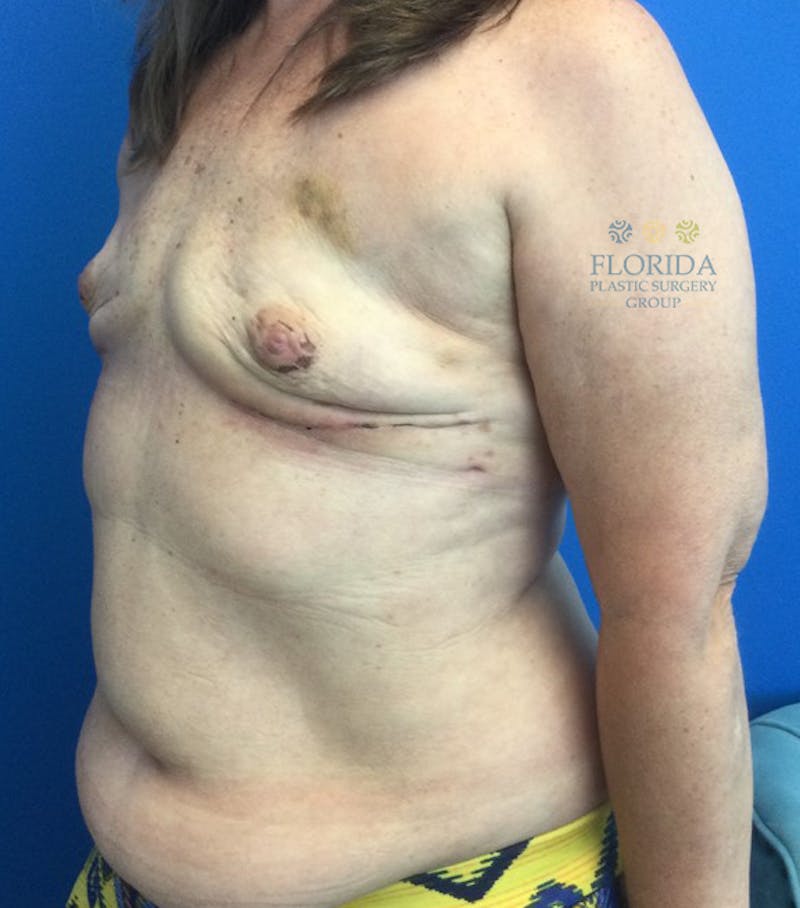 DIEP Flap Reconstruction Before & After Gallery - Patient 154952197 - Image 3