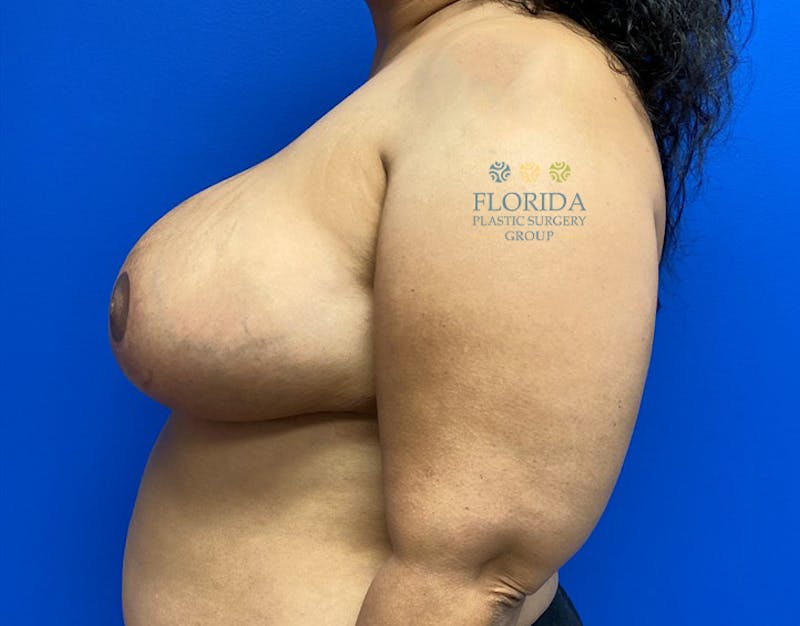Breast Reduction Before & After Gallery - Patient 154952196 - Image 6