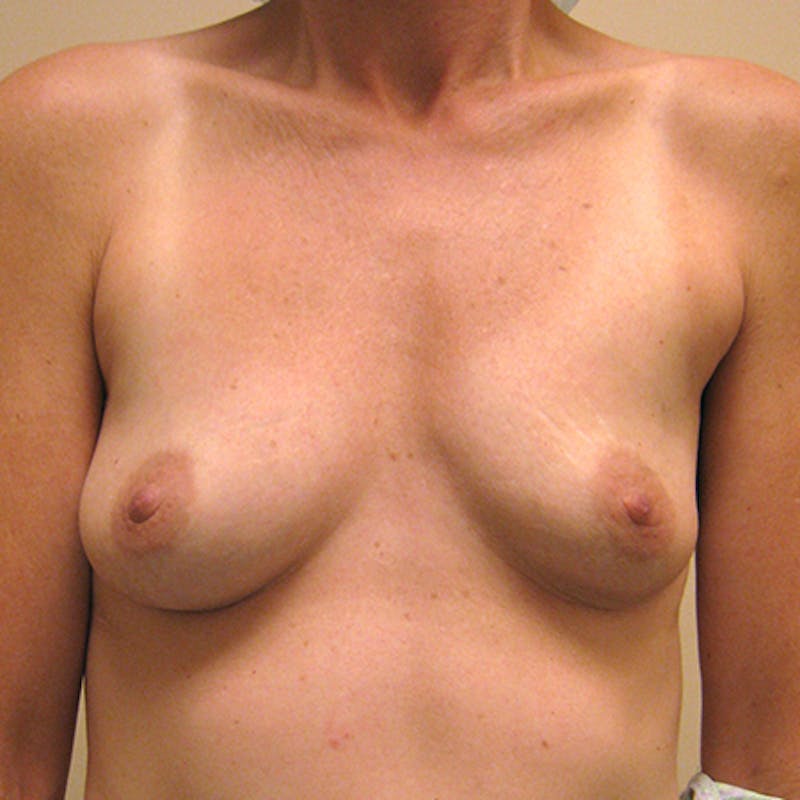 Silicone Breast Augmentation Before & After Gallery - Patient 154952198 - Image 1