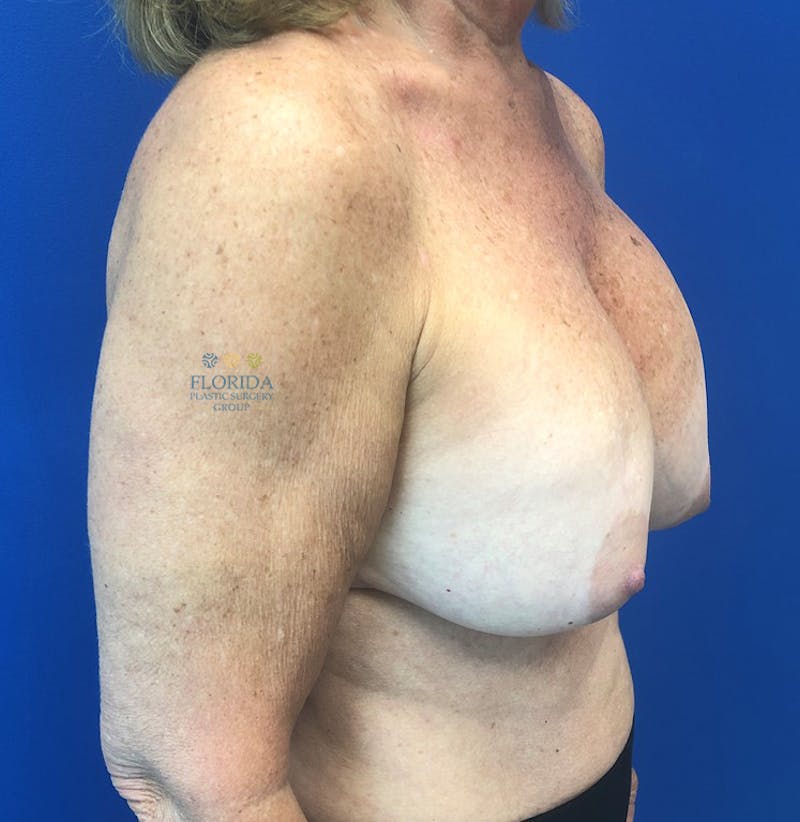Revision Breast Surgery Before & After Gallery - Patient 154952199 - Image 3