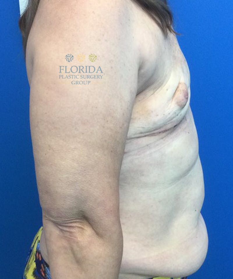DIEP Flap Reconstruction Before & After Gallery - Patient 154952197 - Image 5