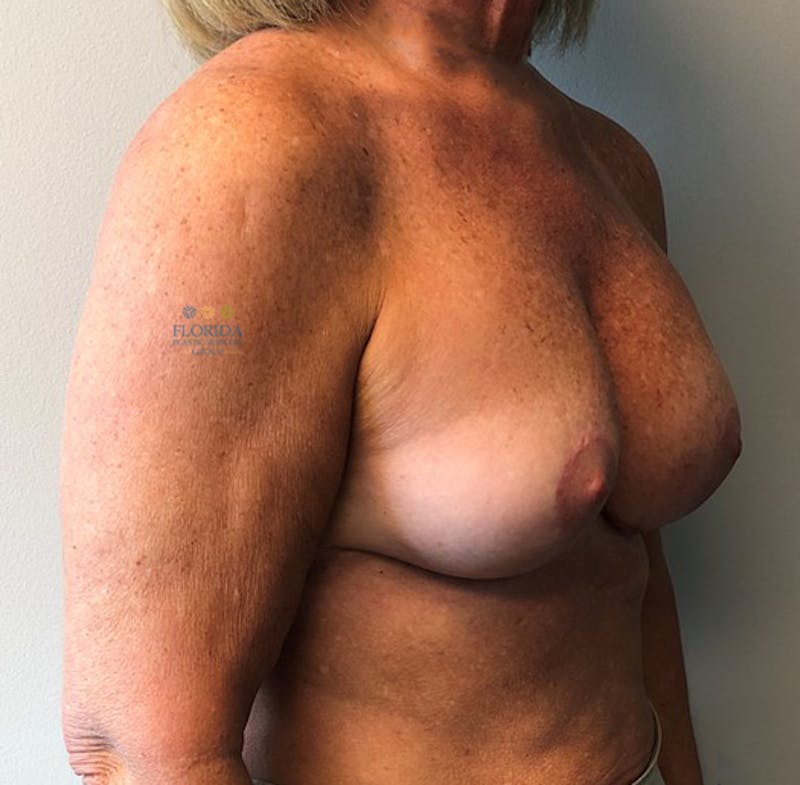 Revision Breast Surgery Before & After Gallery - Patient 154952199 - Image 4