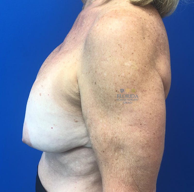 Revision Breast Surgery Before & After Gallery - Patient 154952199 - Image 5