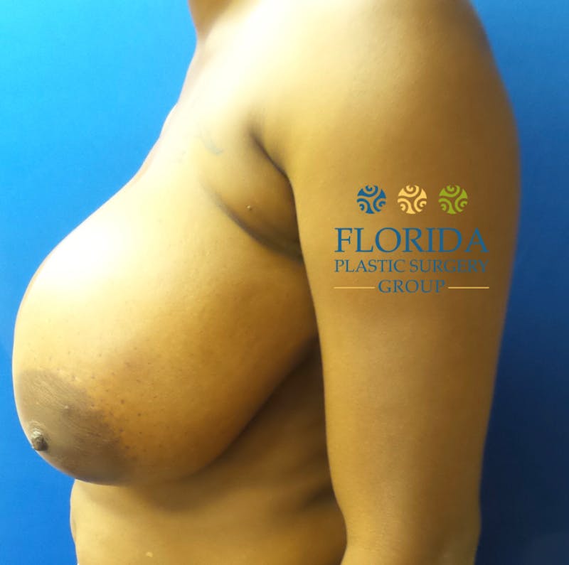 Breast Reduction Before & After Gallery - Patient 154952202 - Image 3