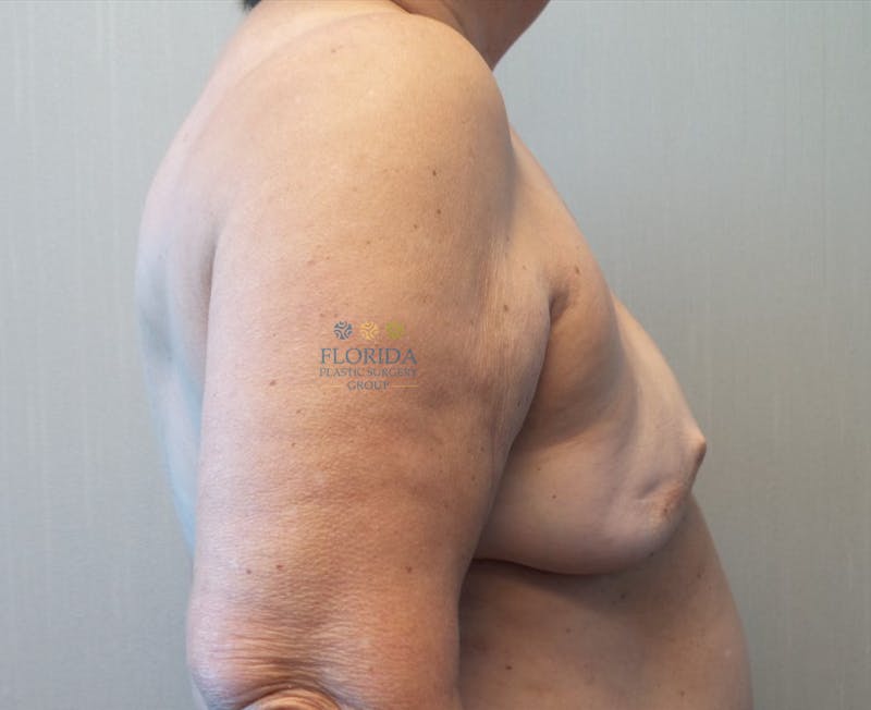 Tissue Expander Reconstruction Before & After Gallery - Patient 154952201 - Image 3