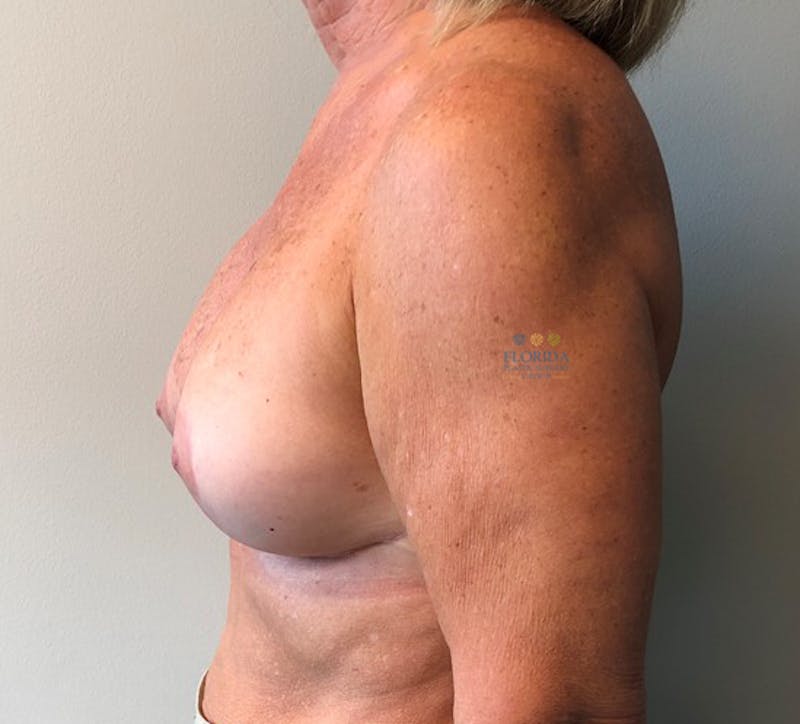 Revision Breast Surgery Before & After Gallery - Patient 154952199 - Image 6
