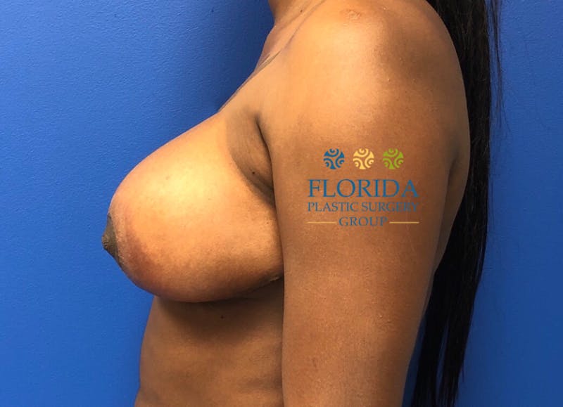 Breast Reduction Before & After Gallery - Patient 154952202 - Image 4