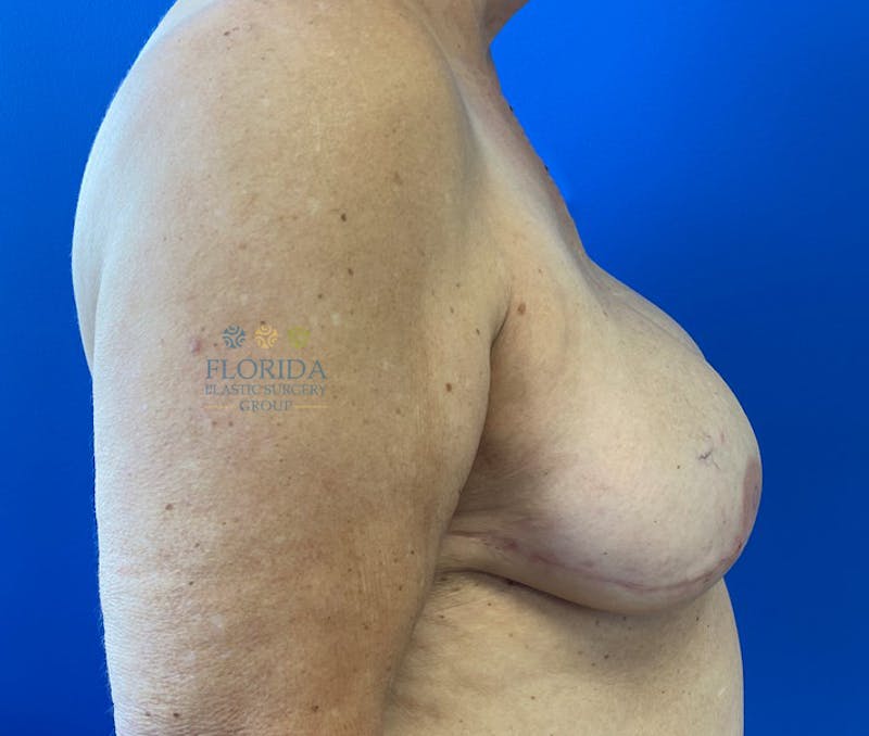 Tissue Expander Reconstruction Before & After Gallery - Patient 154952201 - Image 4