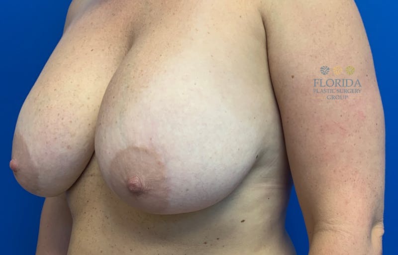Revision Breast Surgery Before & After Gallery - Patient 154952207 - Image 3