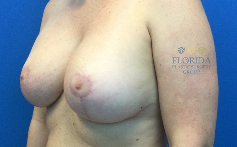 Revision Breast Surgery Before & After Gallery - Patient 154952207 - Image 4