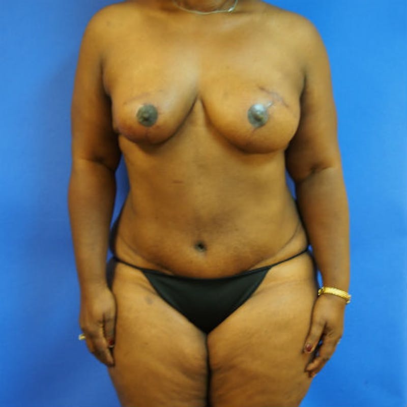 DIEP Flap Reconstruction Before & After Gallery - Patient 154952210 - Image 2