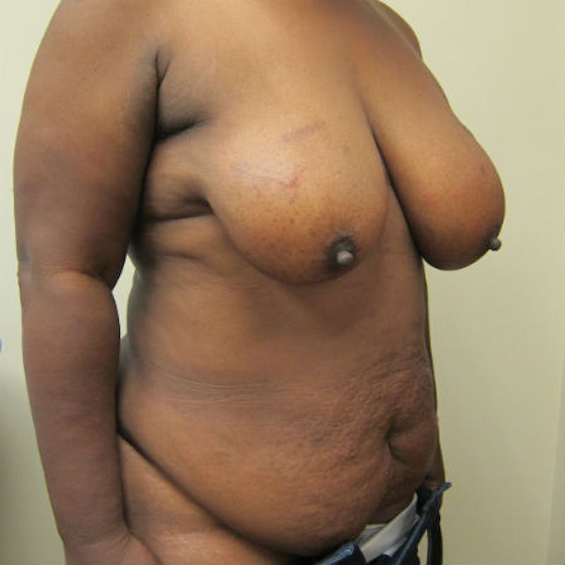 DIEP Flap Reconstruction Before & After Gallery - Patient 154952210 - Image 3