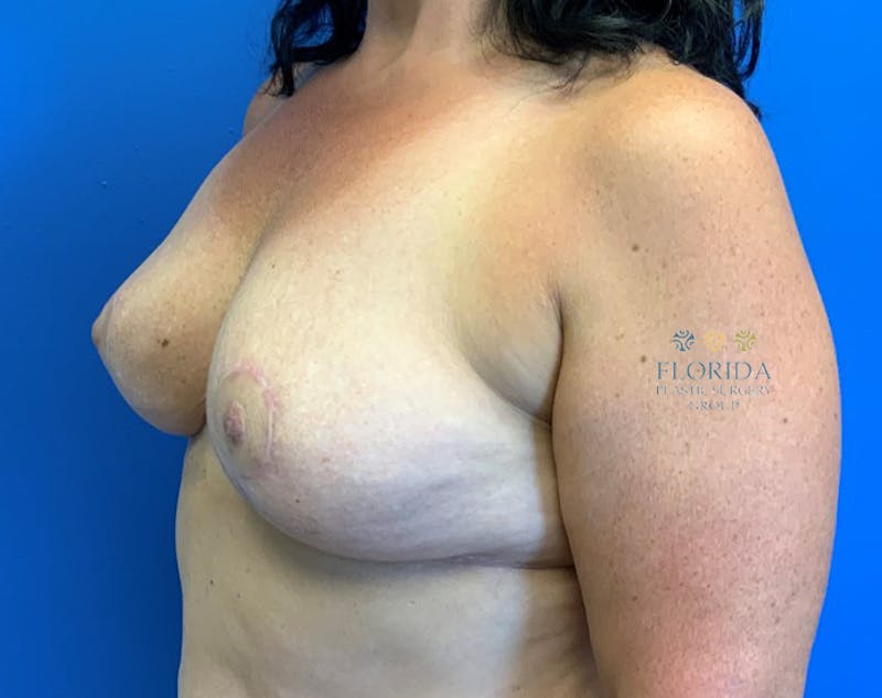 Revision Breast Surgery Before & After Gallery - Patient 154952212 - Image 4