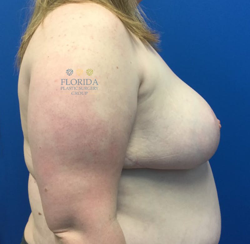 Breast Reduction Before & After Gallery - Patient 154952211 - Image 4